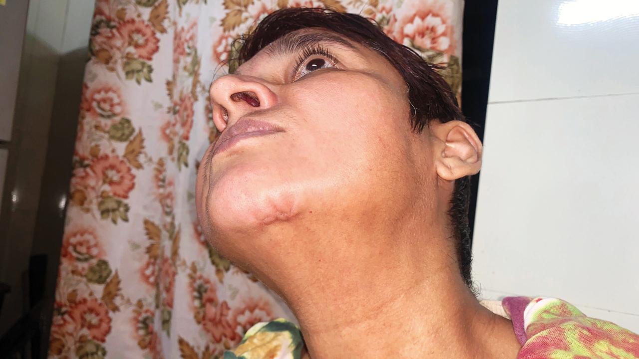 Marietta shows the injury mark on her chin due to an alleged assault by accused Peter
