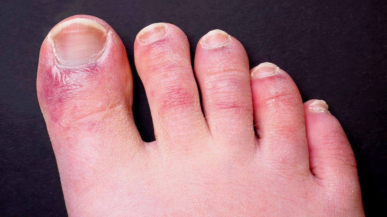 Experts now warn about ‘Covid toes’