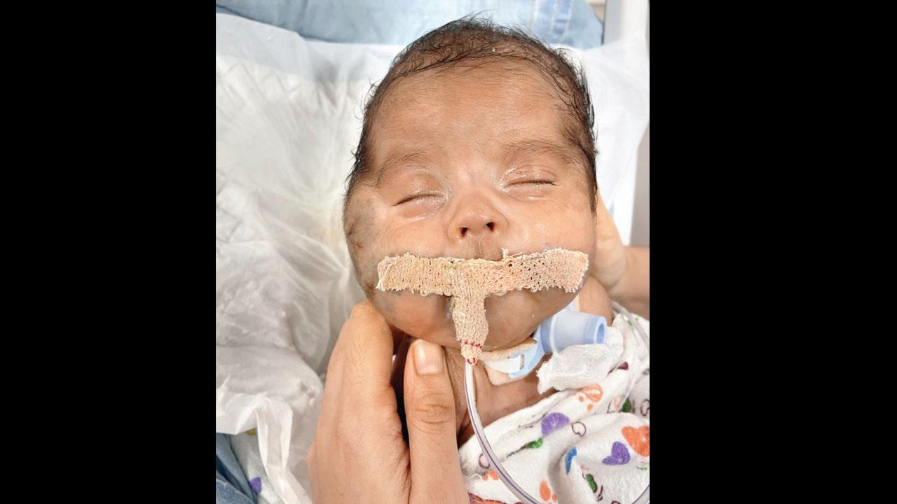 Mumbai: Premature 14-day-old beats huge, rare tumour on the face