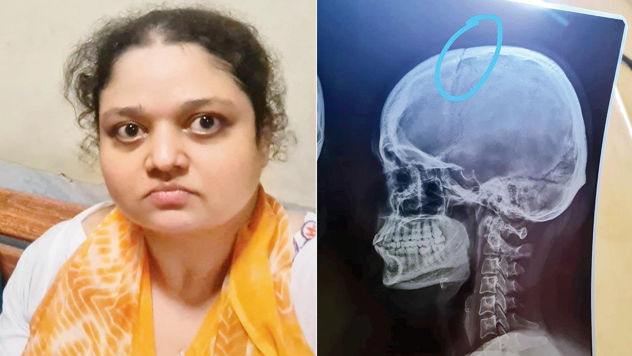 33-year-old veterinarian gets beaten up for feeding crows
Amid rising cases of harassment of animal feeders in the city, a 33-year-old woman veterinary doctor was allegedly beaten up by a mother-son duo over feeding animals and birds on the society premises on Friday. The accused allegedly beat her up with tree branches, leading to a skull fracture and other injuries. Agripada police have filed a case and are yet to arrest the accused.