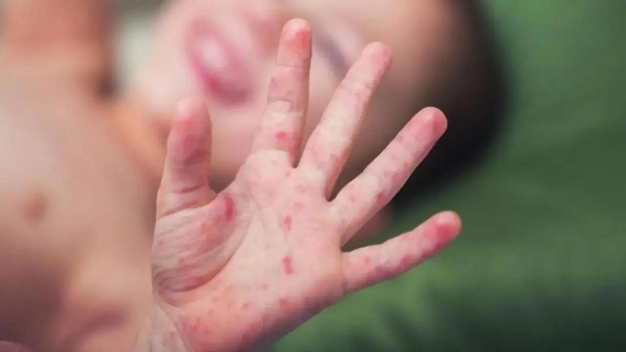 Mumbai: Four-year-old dies of measles in Kurla