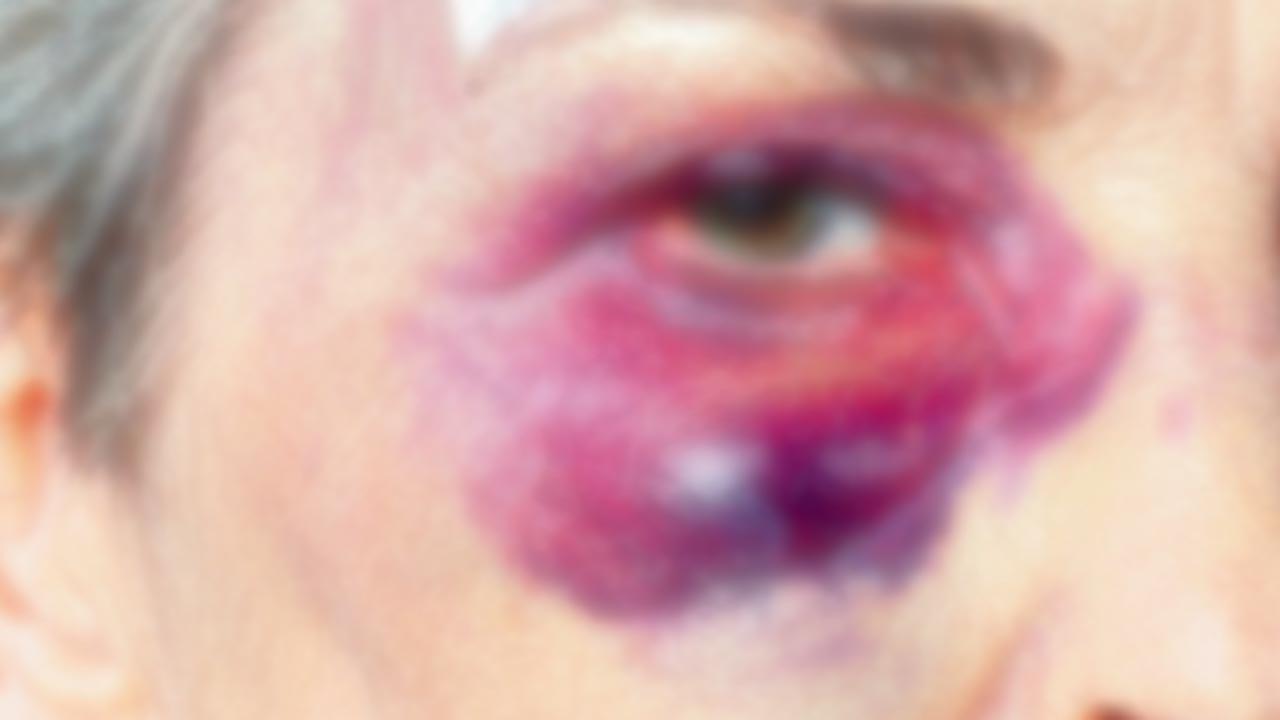 Woman badly injured after man hurls stone at her in Borivli