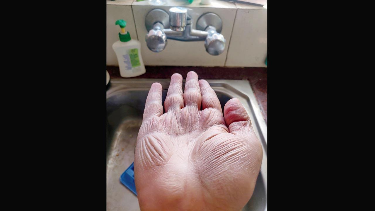 Covid-19 pandemic led to relapse of recovering OCD patients, say Mumbai doctors