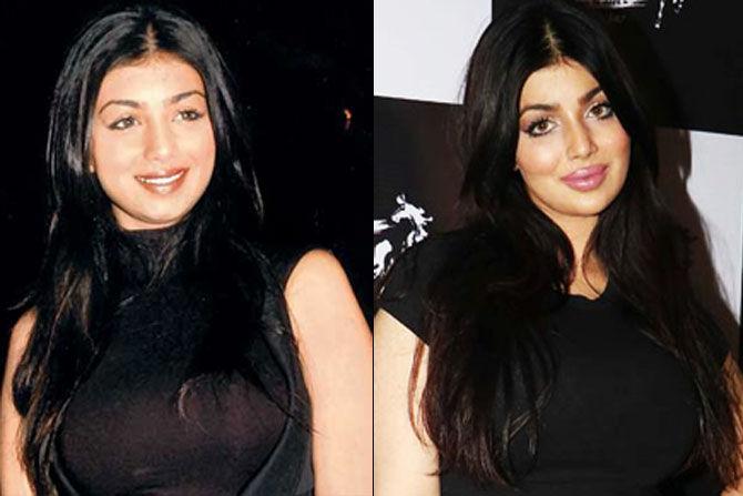 In September 2016, Ayesha Takia was subjected to rumours of having had a lip enhancement surgery because of her fuller lips. The photos on her Instagram account took the internet by storm. However, these reports were not confirmed