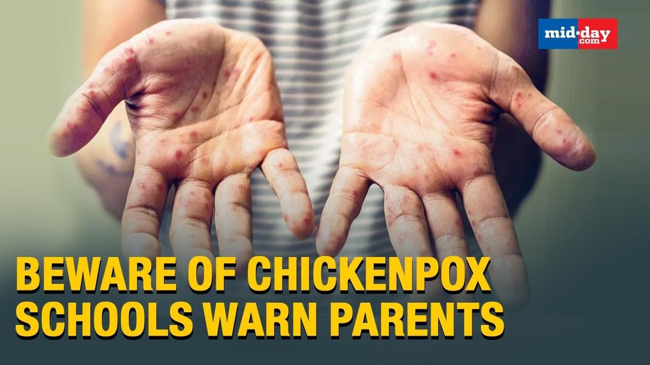 Mumbai: Beware Of Chickenpox, Schools Warn Parents, Issue Advisories