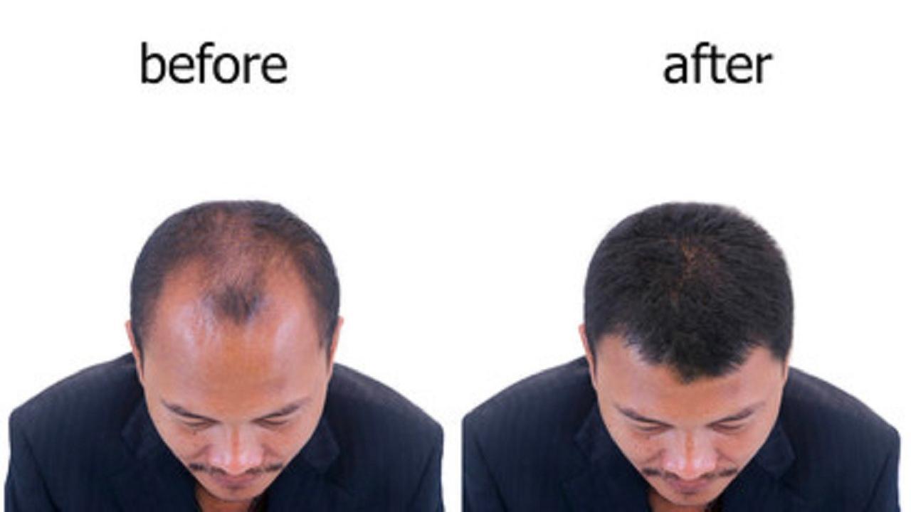 Top 5 Hair Transplant Clinics in Istanbul and Hair Transplant Costs in  Turkey