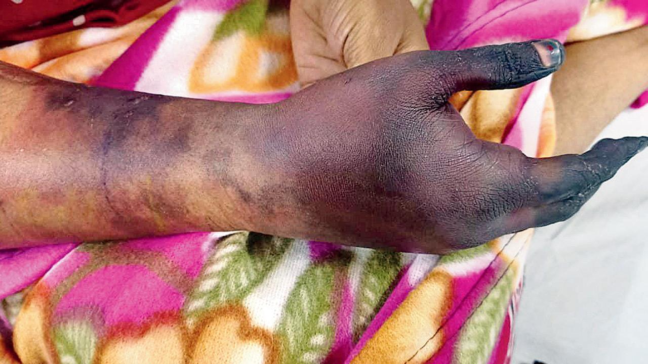Woman loses hand after botched surgery at Vasai hospital