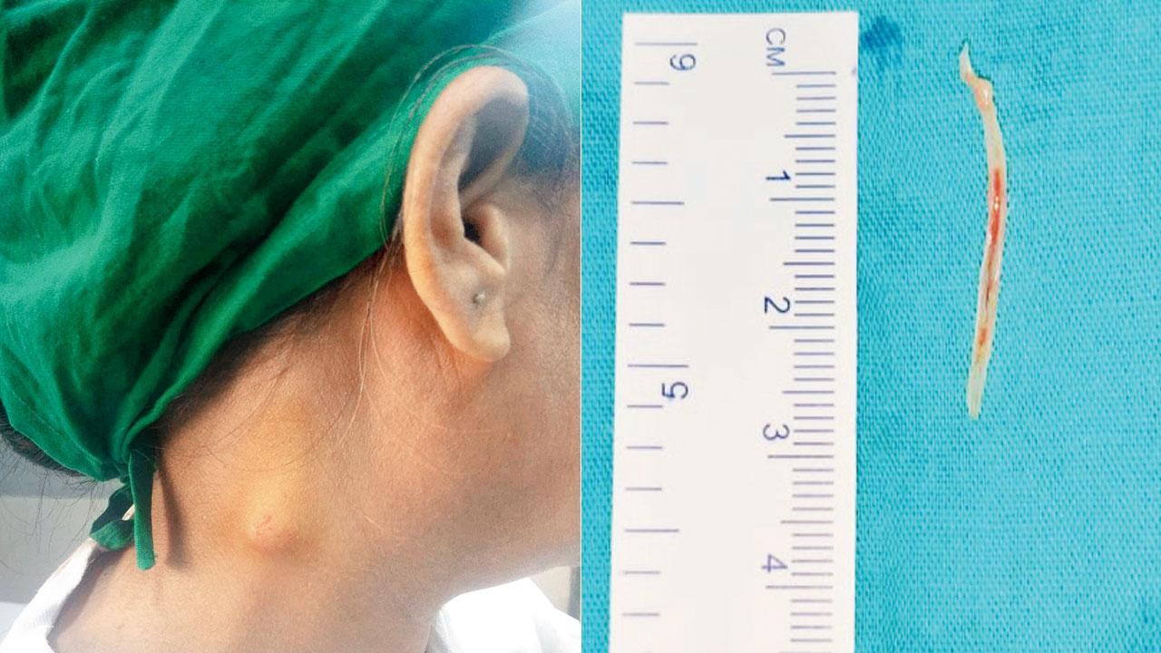 Badlapur woman has fishbone in throat for 15 days!