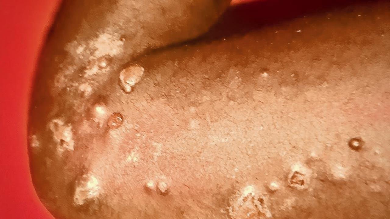 Monkeypox not a cause for alarm in India yet, say experts