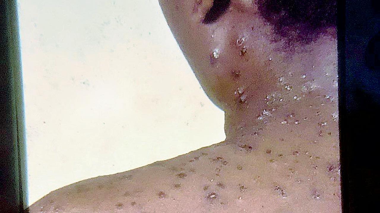 Monkeypox rashes on the body of a patient. Pic/Dr Subhash Hira