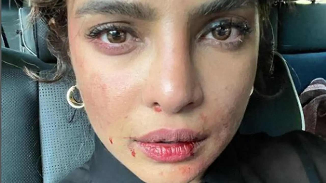Priyanka Chopra shared a picture of her bruised face from the sets of her series 'Citadel'. Priyanka posted the picture on Instagram and asked her followers if they too were having a tough day at work. Read full story here