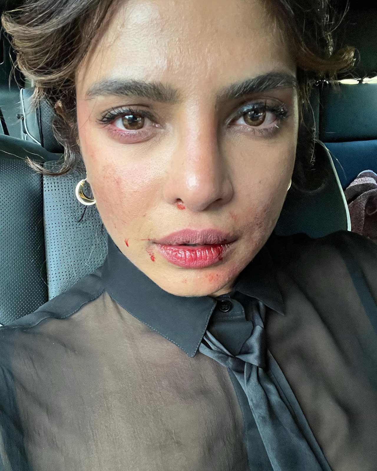 Priyanka Chopra shared a picture of her bruised face from the sets of her series 'Citadel'. Priyanka posted the picture on Instagram and asked her followers if they too were having a tough day at work. Sharing the picture, Priyanka wrote: 