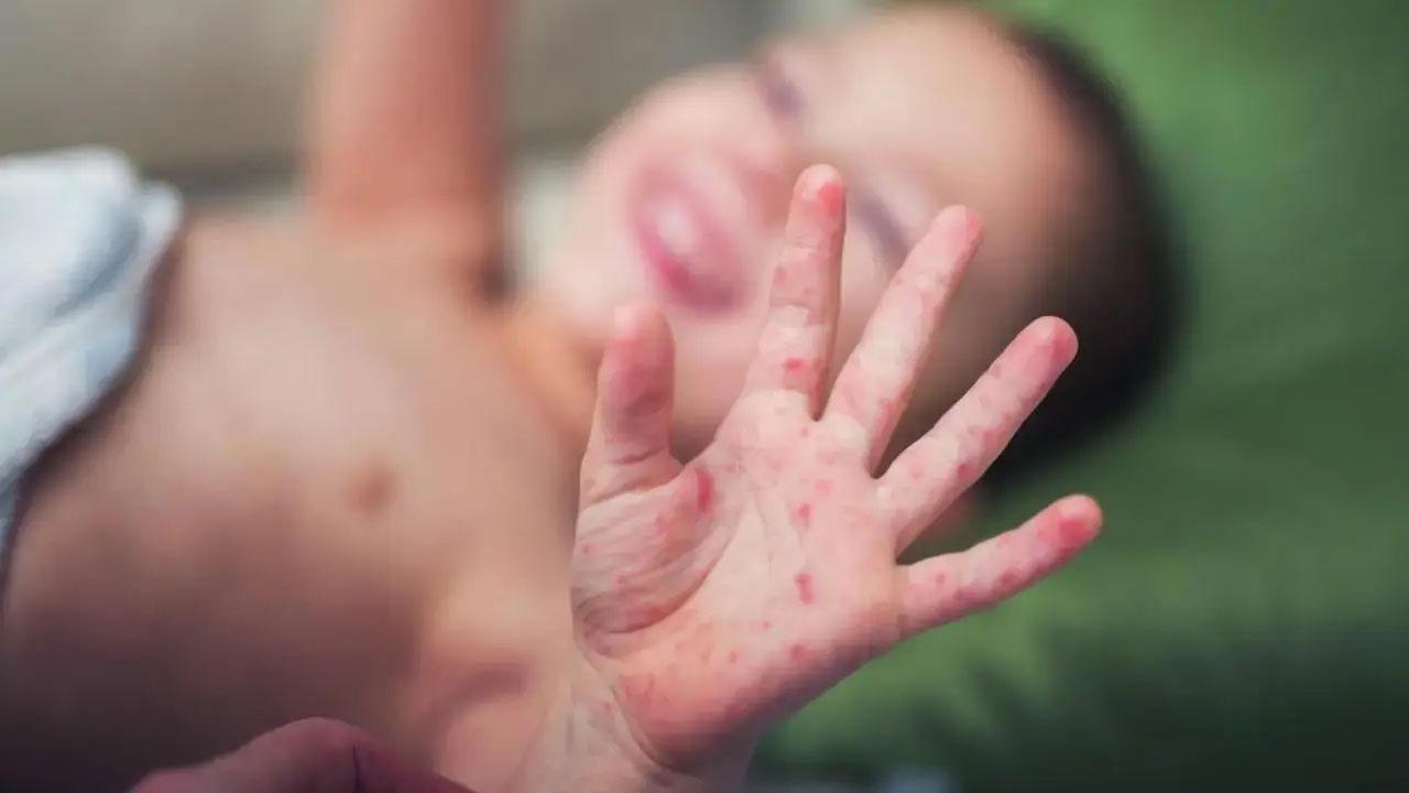 Mumbai: Measles cases spread into island city now