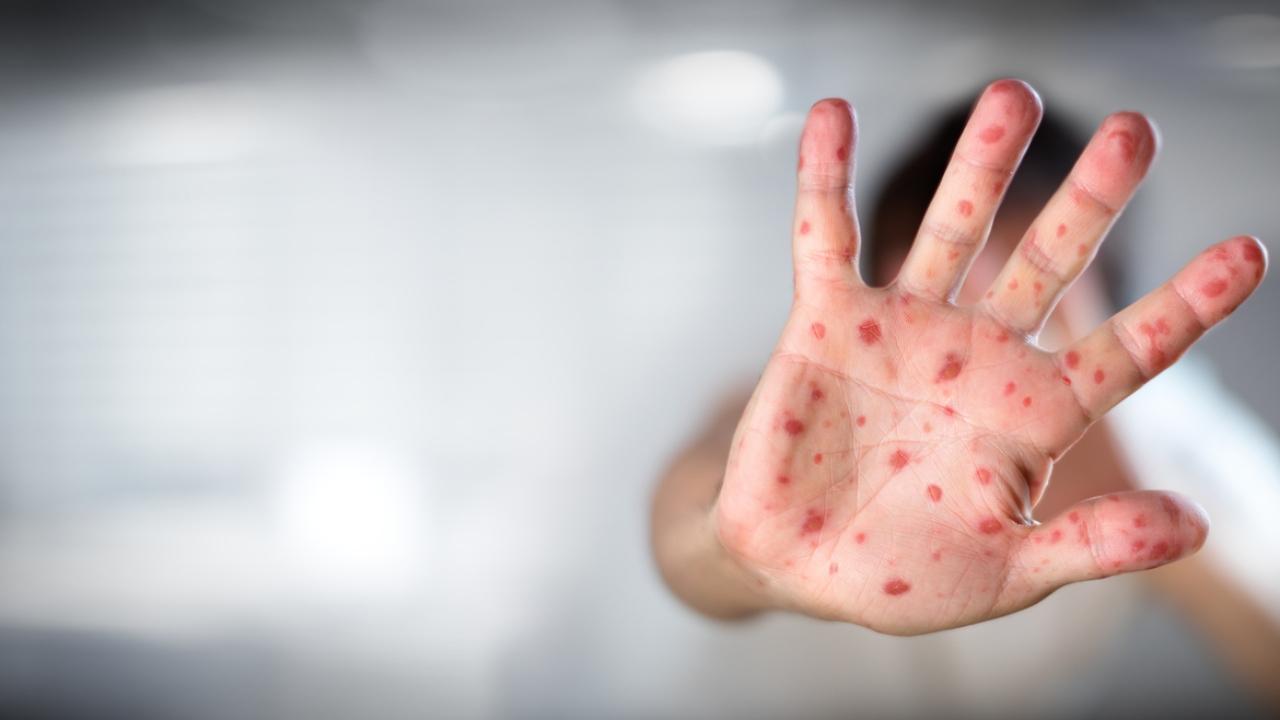 Measles outbreak: 61 suspected patients admitted in Kasturba hospital this month