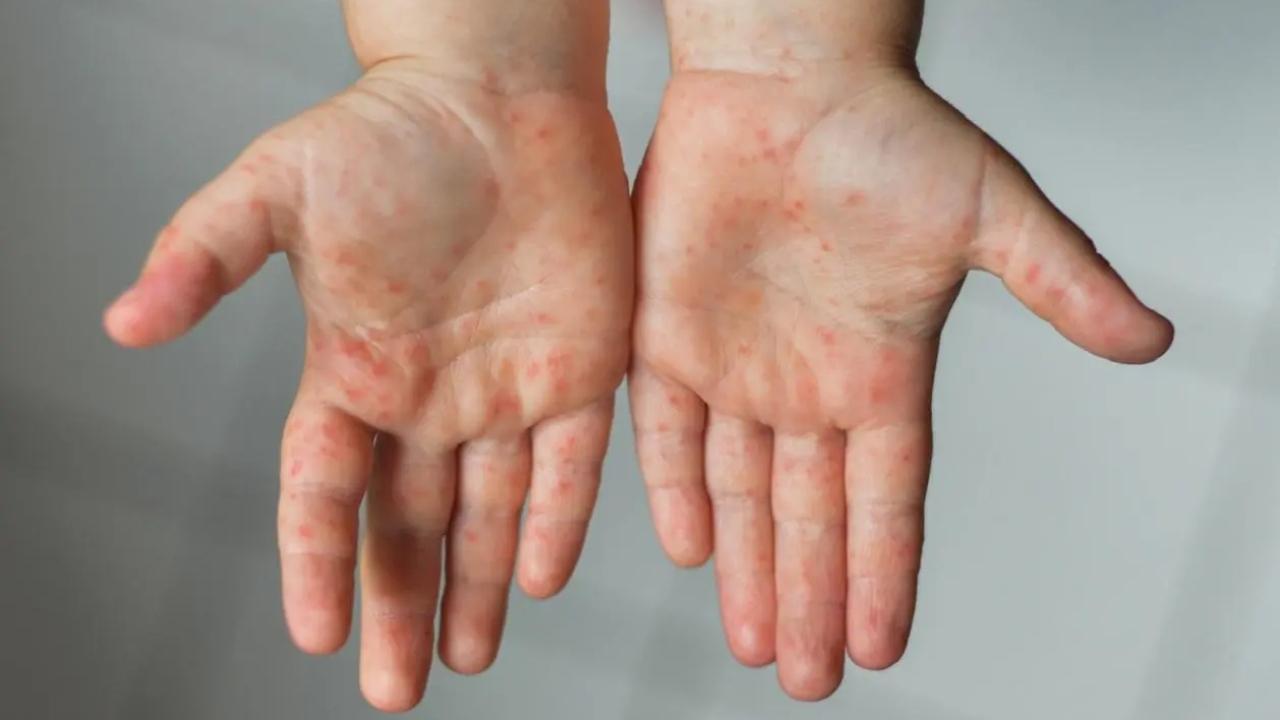 Measles outbreak in Mumbai: One more child dies, toll reaches to 12