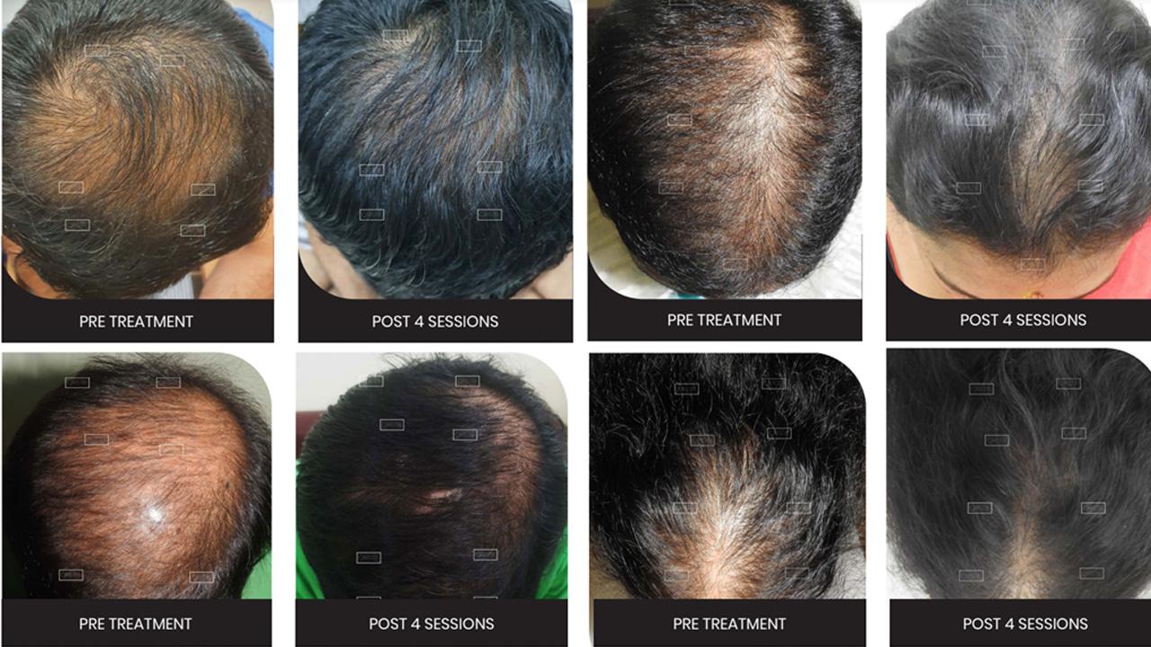 QR 678: A new age solution for Hair Loss and Hair Growth