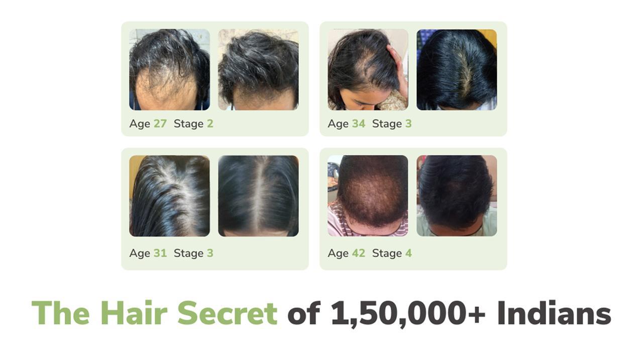 How This Hair-Loss Solution Start-Up Is Setting New Benchmarks: A Glance  Into Traya Reviews
