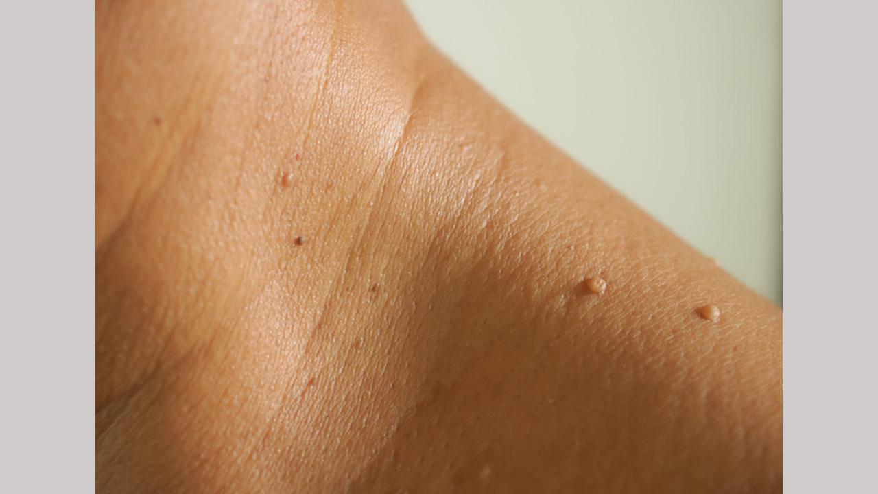 Cryogen Skin Tag Remover Reviews SCAM EXPOSED Must You Need to Know [Radiant