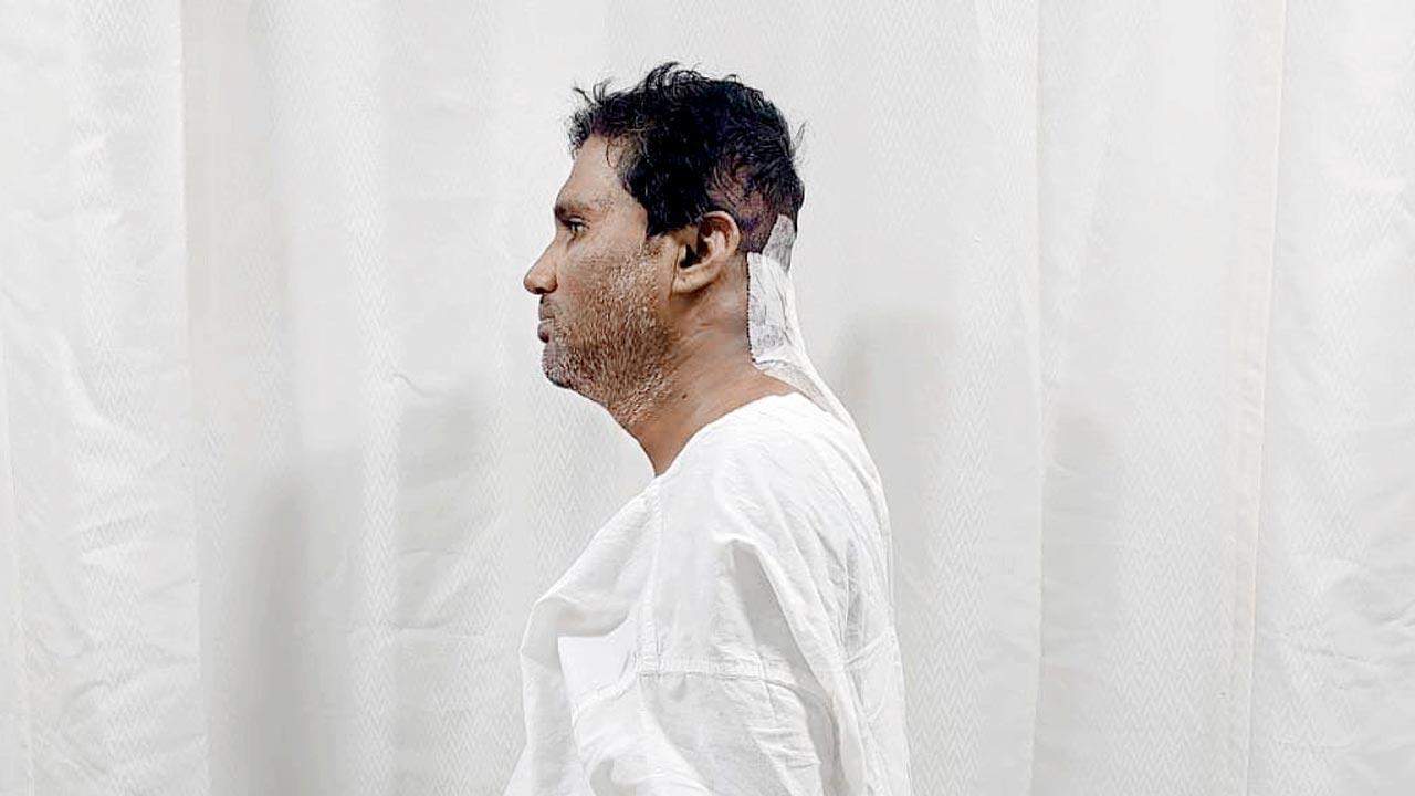 Mumbai: Man’s neck straightened after risky life-saving op