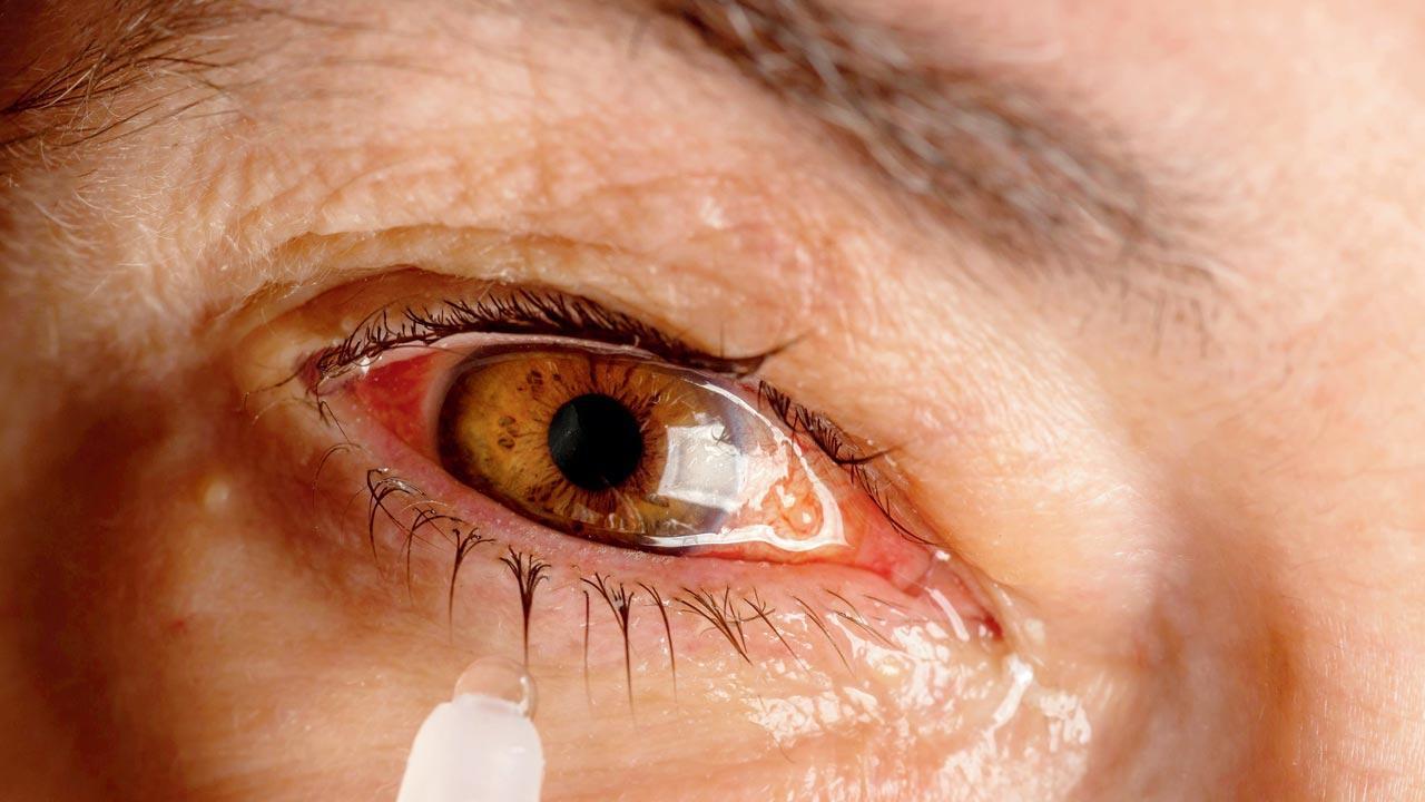 BMC issues warning for city as conjunctivitis cases surge in state