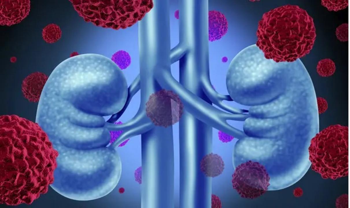 Consuming added sugars elevates risk of kidney stones: Study