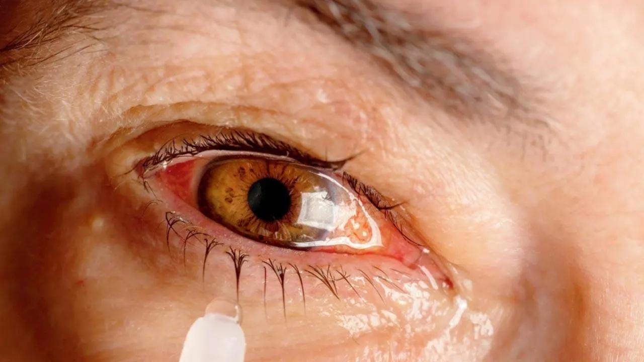 Pink eye: Causes and prevention tips 