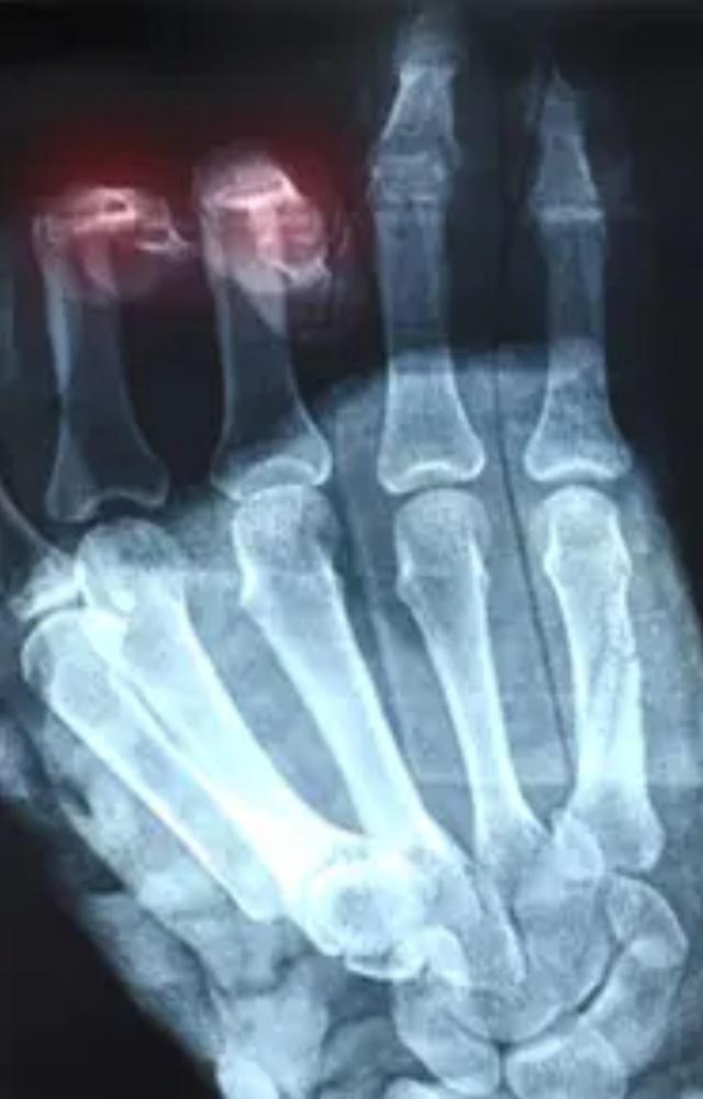 5 signs of weak bones