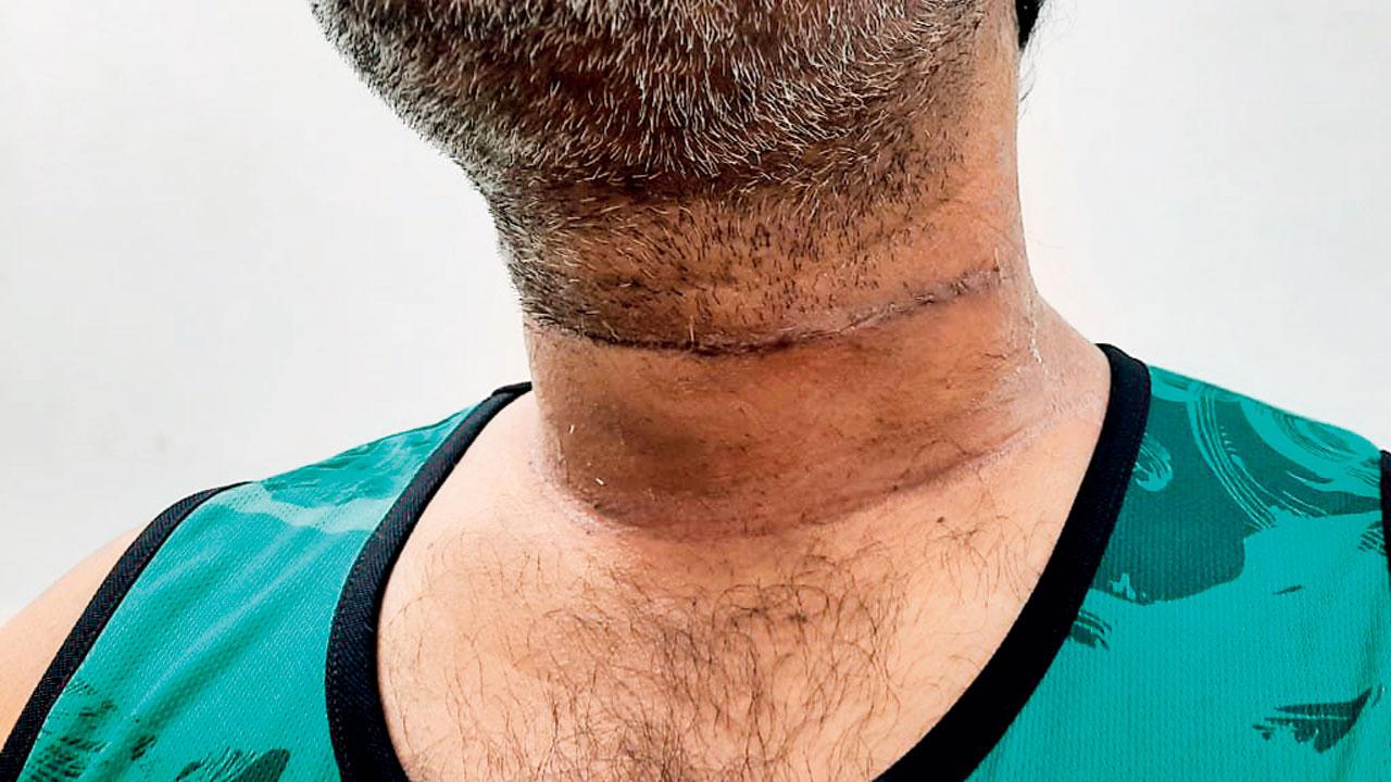 API Rakesh Gawli’s neck after the surgery