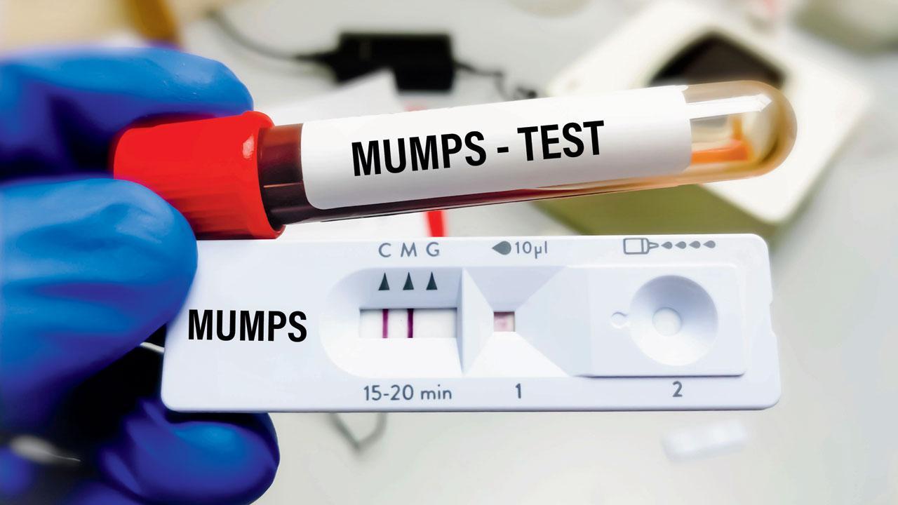 Mumbai: No need to worry, says BMC, even as mumps cases rise in M-East ward