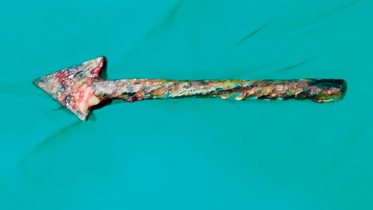 Doctors removed the 4-inch spear-shaped fencing rod from the arm of Sumedh Jadhav