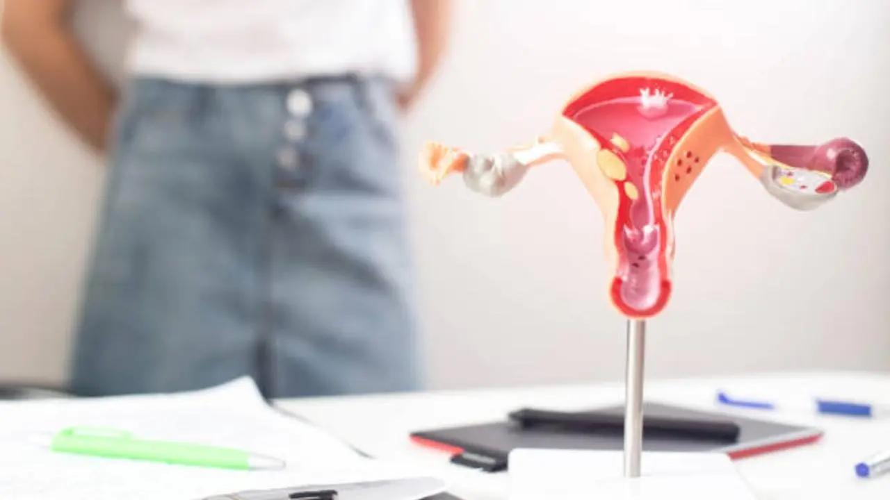 Navigating PCOS: An expert home-based guide to combat the ovarian disorder