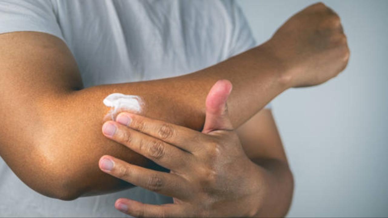 Steroid creams to treat inflammatory skin condition may affect bone health