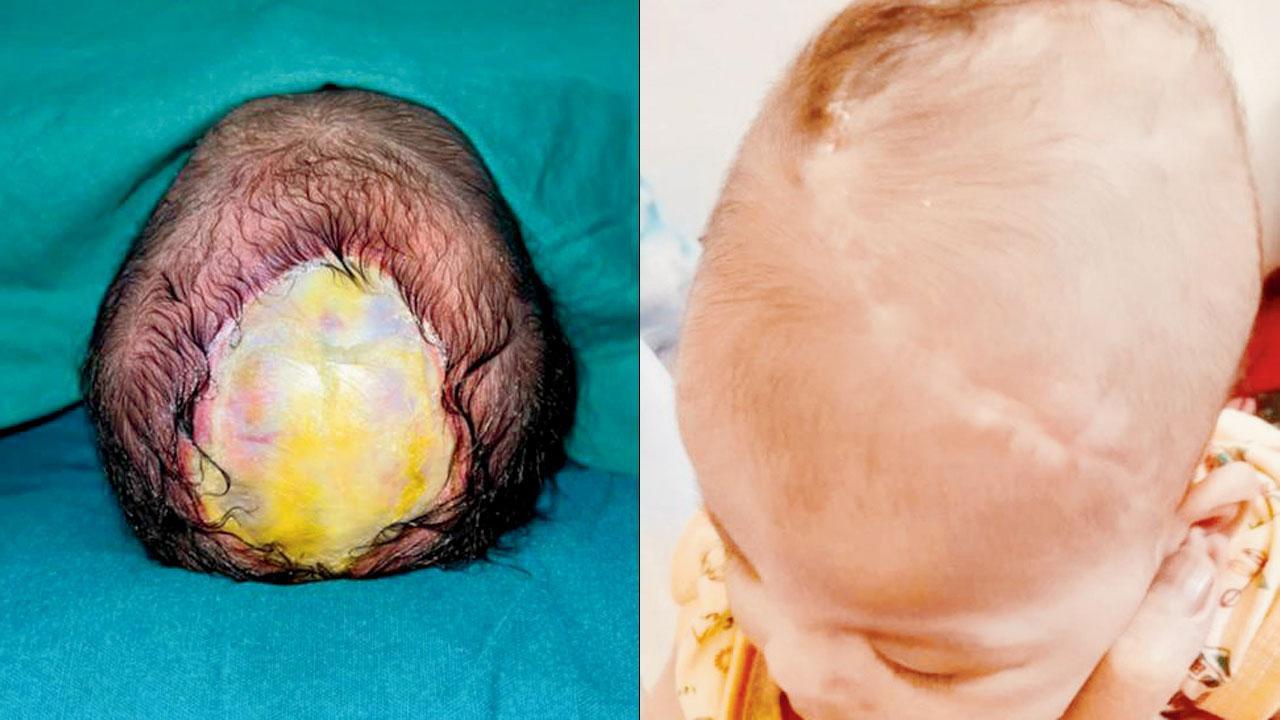 baby born without head