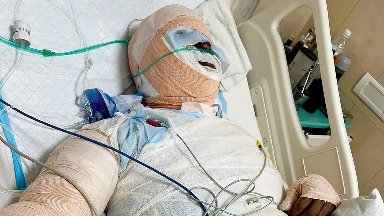 Mumbai Crime: After 18-days battle for life, acid attack victim dies in hospital