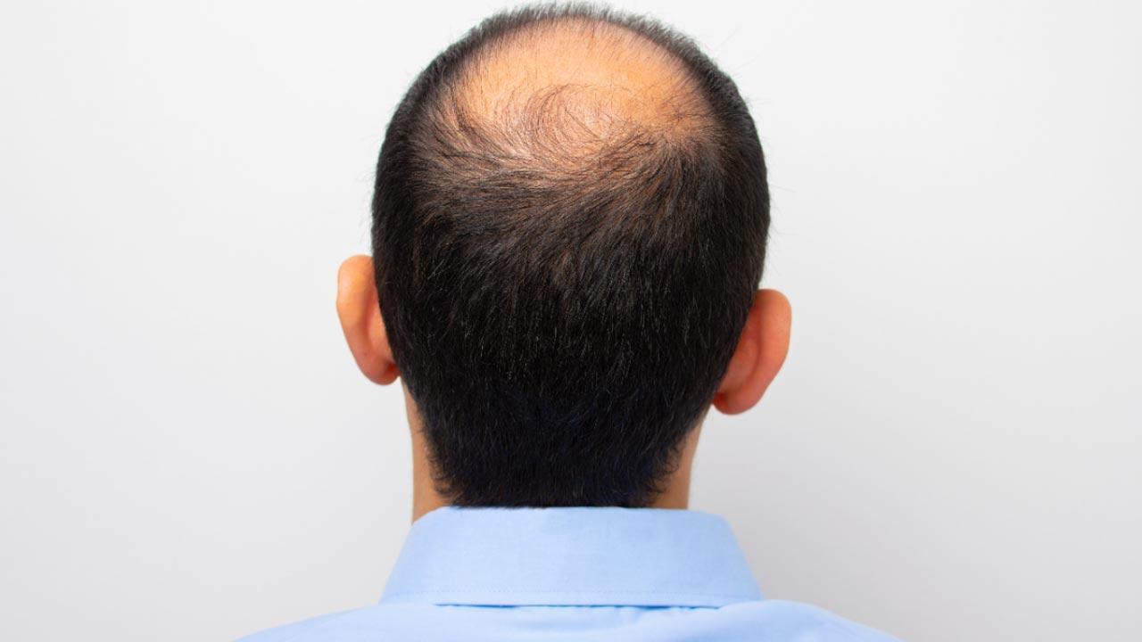 Shamed for balding? Experts dissect how it hampers mental health and workplace dynamics