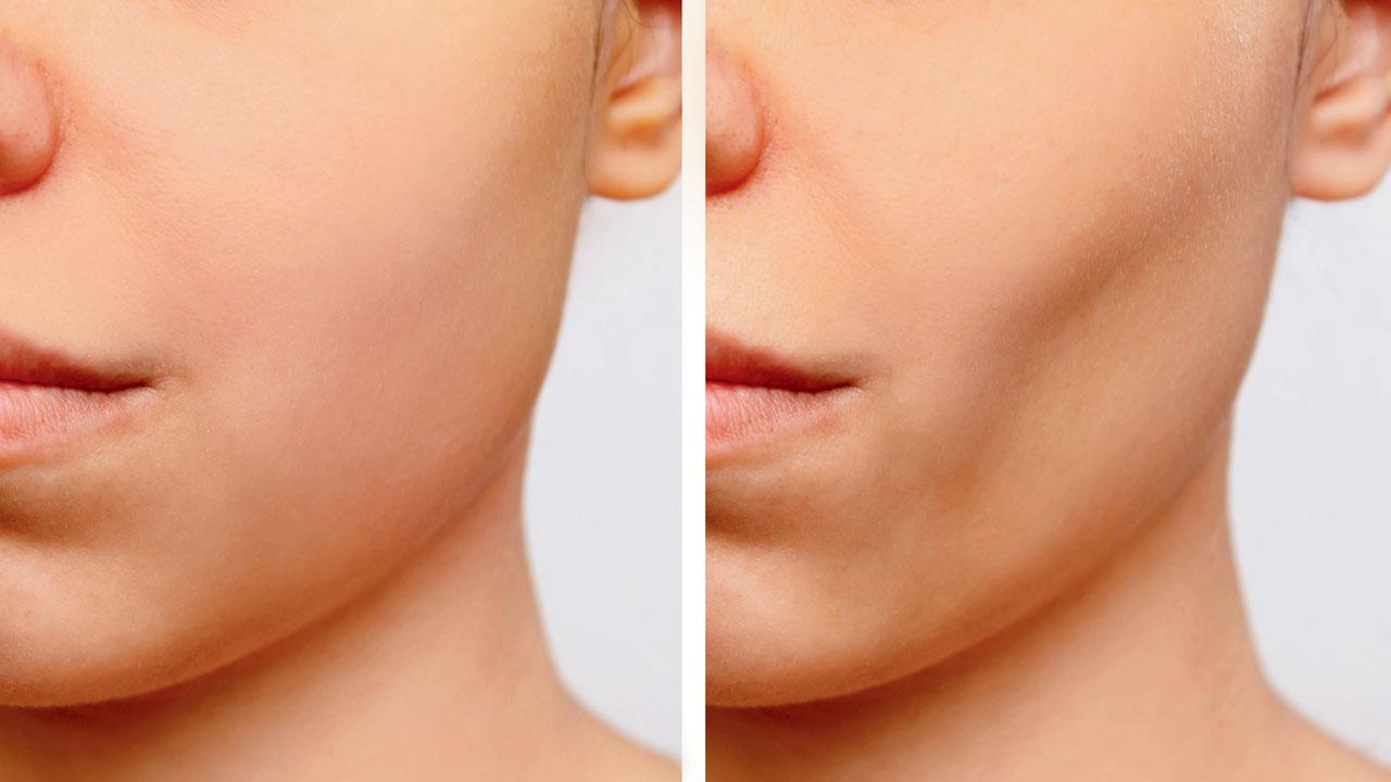 Buccal fat removal surgery involves making a small incision inside the mouth to remove fat tissue, thereby making the lower cheek appear contoured and slimmer. REPRESENTATION PIC