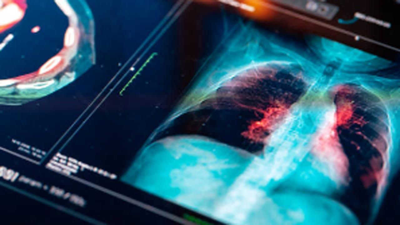 Study: Researchers test AI tool that may  accurately predict risk of lung cancer