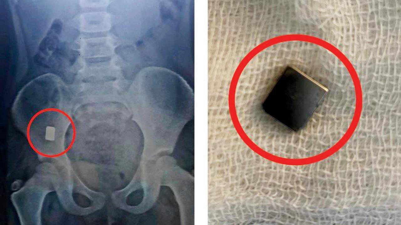 Magnet removed from 4-year-old via colonoscopy