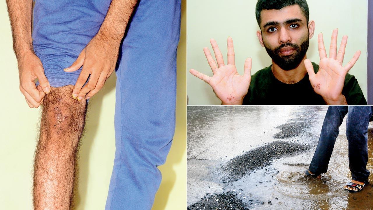 Pothole menace: Youth injured in accident on Goregaon-Mulund Link Road