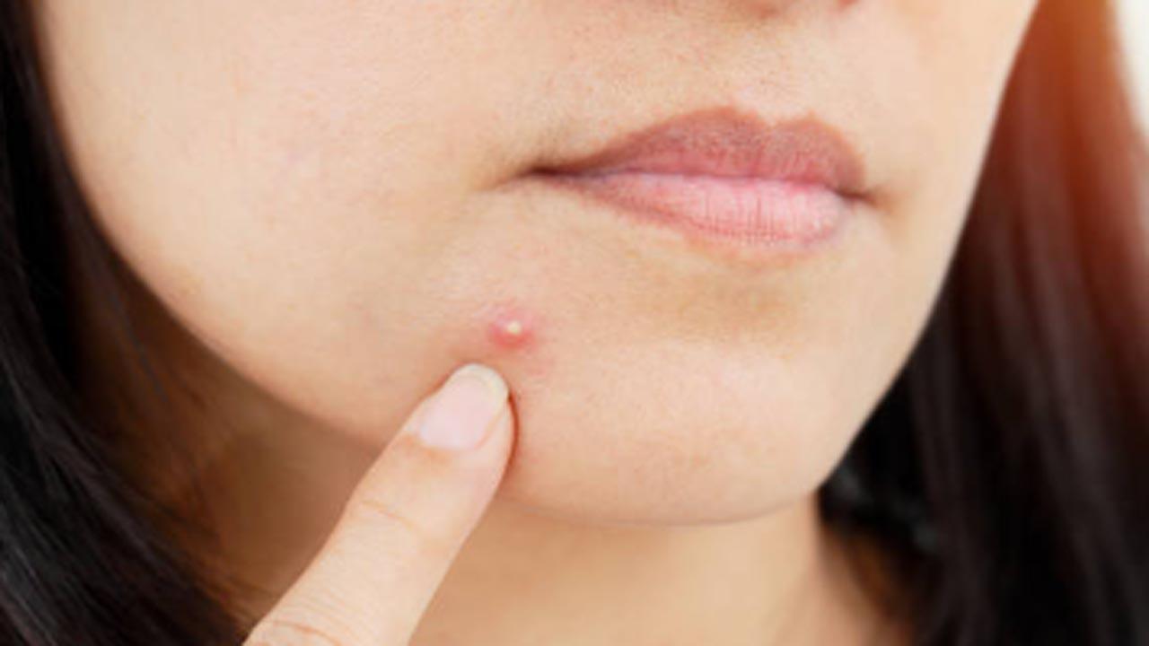 Skincare experts bust myths around pimples