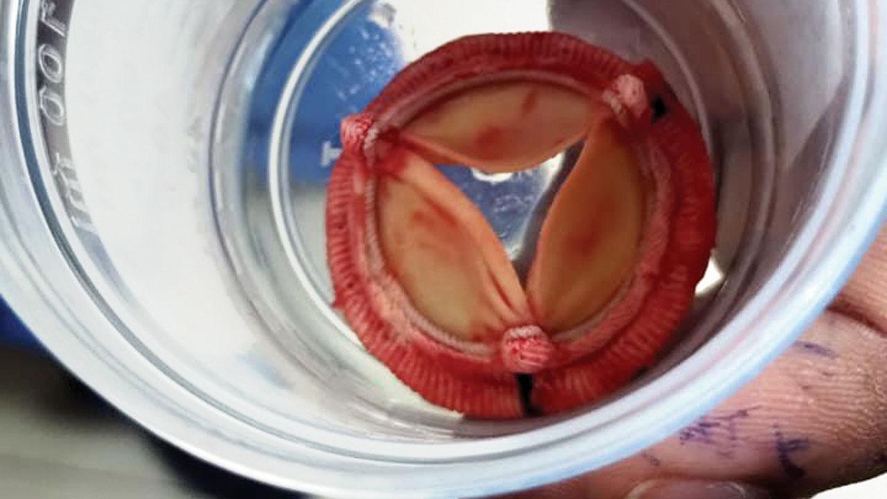 The defective valve