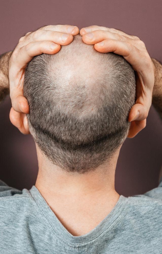 Tips to deal with stigma around balding