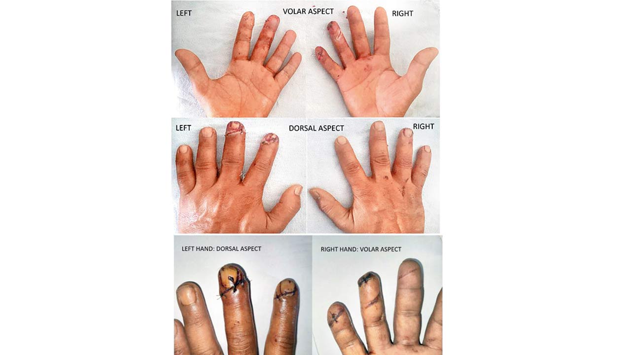 Nitish Bansal, Saurabh Aggarwal and Punit Tiwari published a report in 2021, available on the National Library of Medicine portal, that discussed the case of a 40-year-old drone operator who suffered injuries on both hands and required sutures and physiotherapy. Pics Courtesy/Nitish Bansal, Saurabh Aggarwal, Punit Tiwari; Delhi Orthopaedic Association