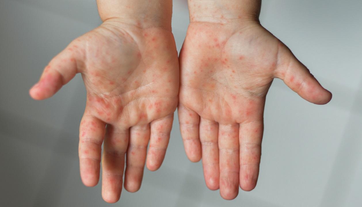 Madhya Pradesh: Indore sees 47 cases of measles in one month; 83 per cent patients unvaccinated