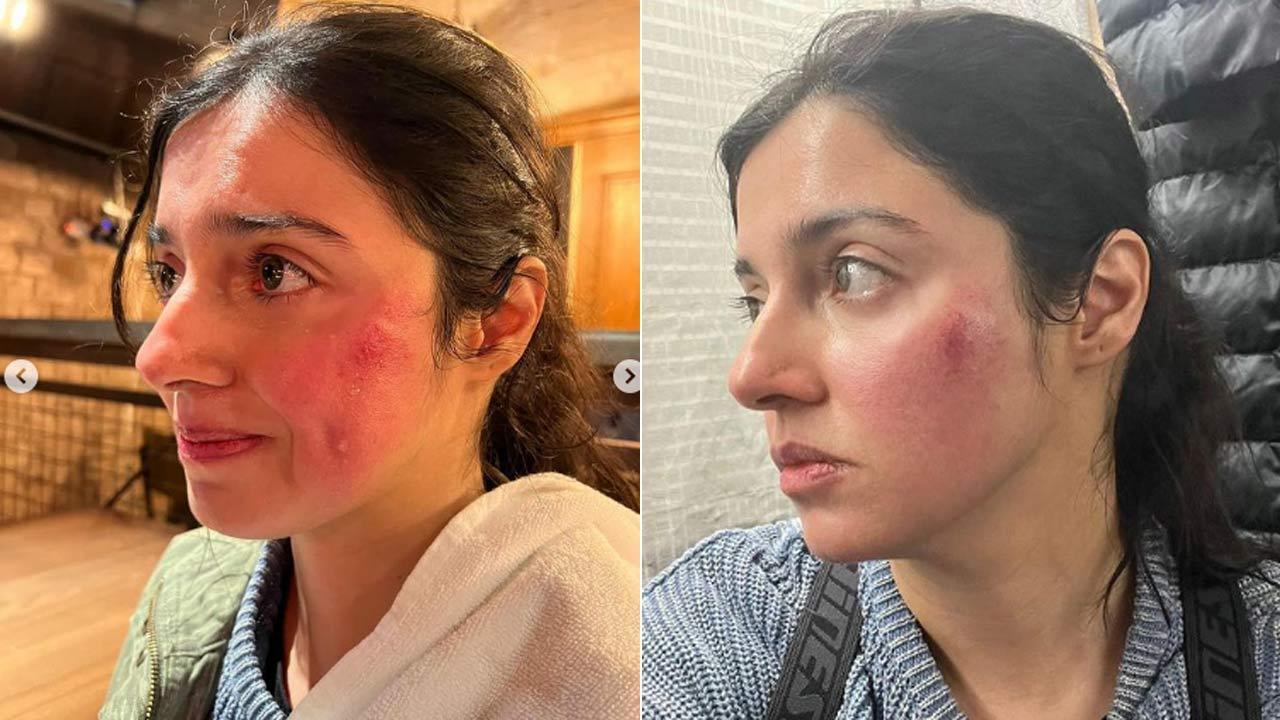 Divya Khosla Kumar gets injured while filming action scenes, check pics