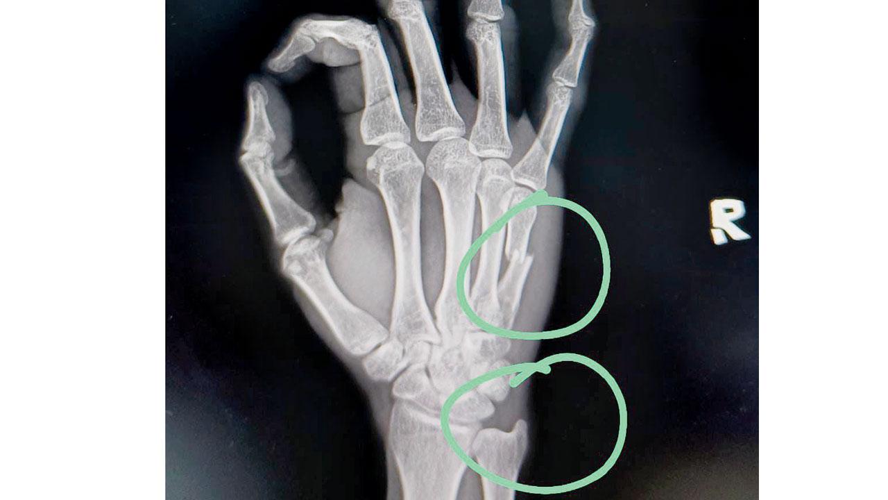 The X-ray of Iqbal’s fractured hand