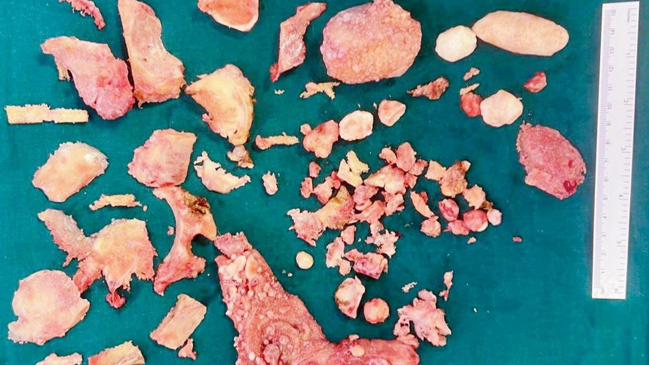 Stones removed from patient Prahlad Pawar’s knees