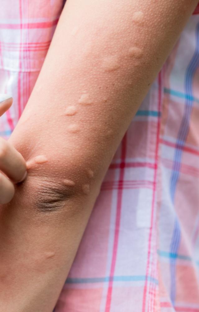 The best way to stay safe from Dengue is to prevent yourself from mosquito bites