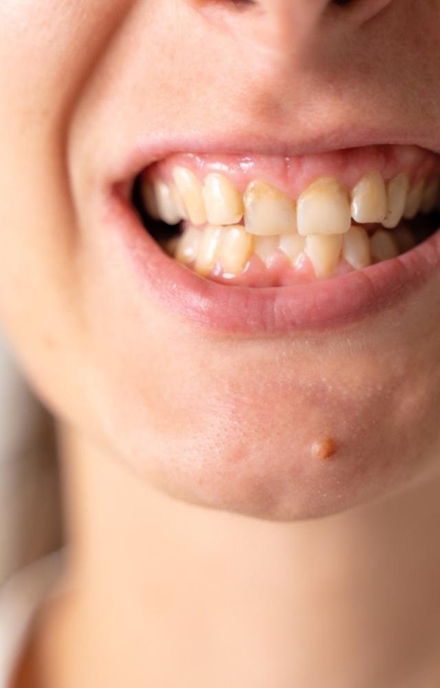 Oral ulcers, dental cavities, dental discolouration, bad breath, loss of teeth, and loss of appetite are some short-term effects of tobacco consumption 
