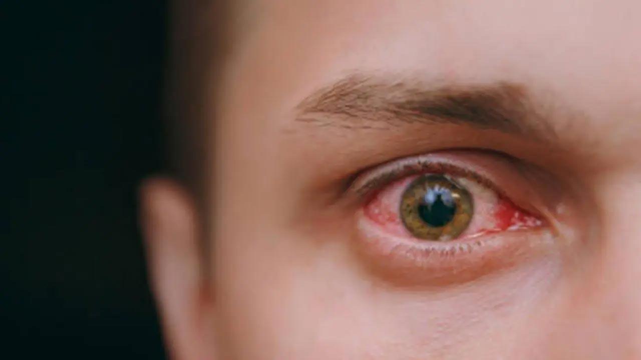 What to do in case of an eye injury due to Diwali crackers? 
